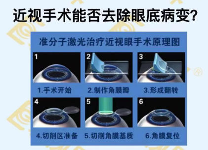 近視手術(shù)能否去除眼底病變？