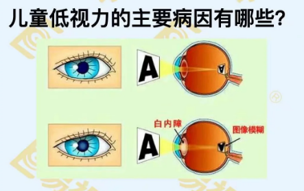 兒童低視力主要病因有哪些？