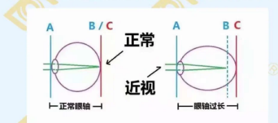 哪個年齡近視度數(shù)最容易增長？