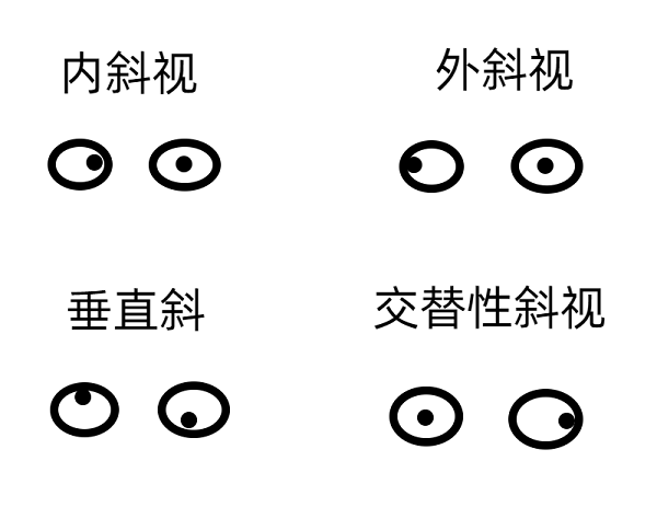 斜視早期的癥狀有哪些？